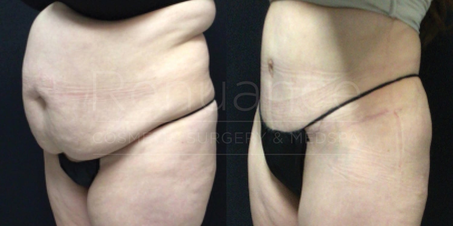 Before and after image of a person showing results from a cosmetic procedure. The left side shows the person's lower abdomen with significant fat and loose skin, while the right side shows a more toned and smooth lower abdomen with less fat and tighter skin.