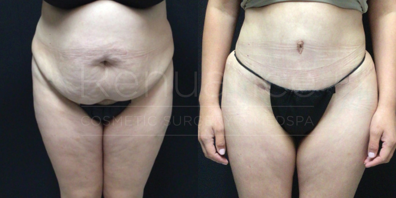A side-by-side comparison shows the before and after results of abdominal cosmetic surgery. The left image illustrates the person's abdomen and thighs with excess skin and fat, while the right image shows the same area after the procedure, with a smoother and more contoured appearance.