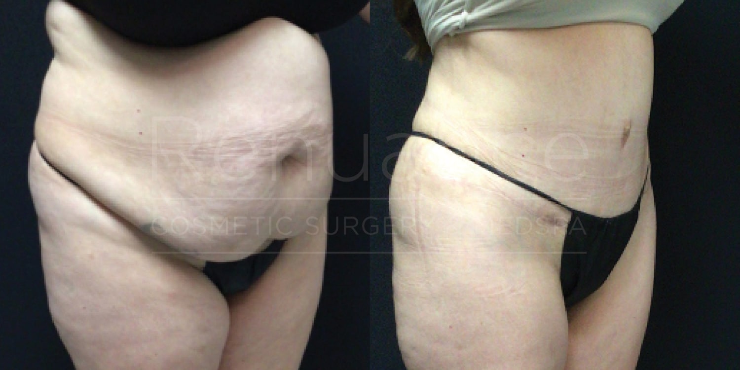 "Before and after images of a person who has undergone a body contouring or cosmetic surgery procedure. The 'before' image shows the individual's midsection with significant sagging and loose skin. The 'after' image displays a much firmer and smoother midsection, indicative of the improvement following the procedure. The person is wearing black underwear in both photos."