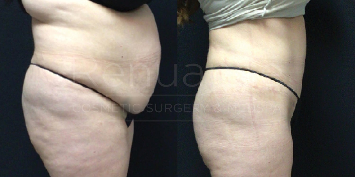 Before and after comparison of a person's midsection and thighs, showing visible reduction in cellulite and skin smoothing after a cosmetic procedure.