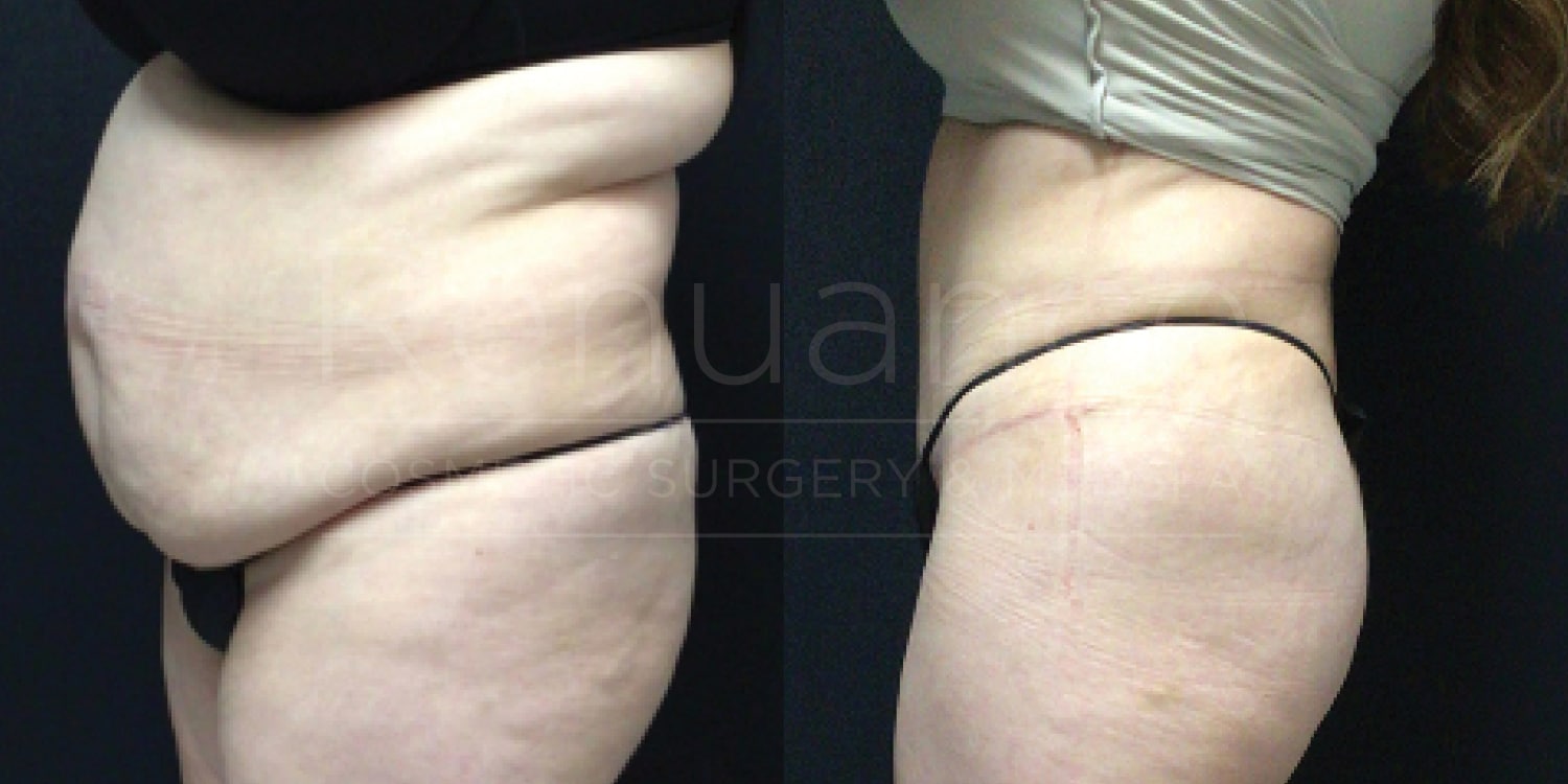 Before-and-after image showing the results of body contouring or weight loss. The left side of the image shows a person with a larger abdomen and waist area, while the right side shows a noticeably slimmer and more toned midsection. The individual is wearing a similar outfit in both photos for comparison.