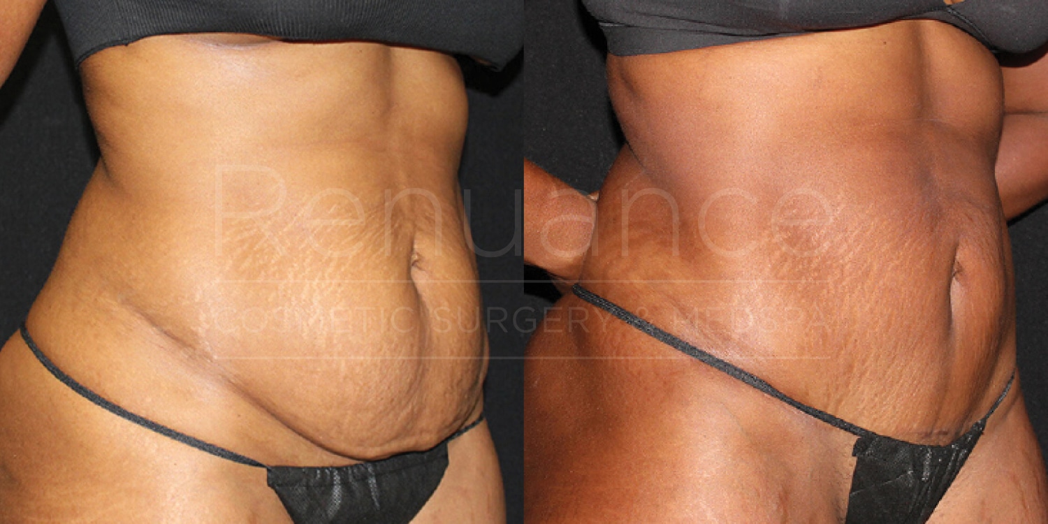 Side-by-side comparison of before and after images showing the results of a cosmetic surgery procedure on the abdomen. The left image displays a woman's midsection with loose skin and some fat, while the right image shows a more toned and tightened appearance with smoother skin. The woman is wearing a black bikini in both images.
