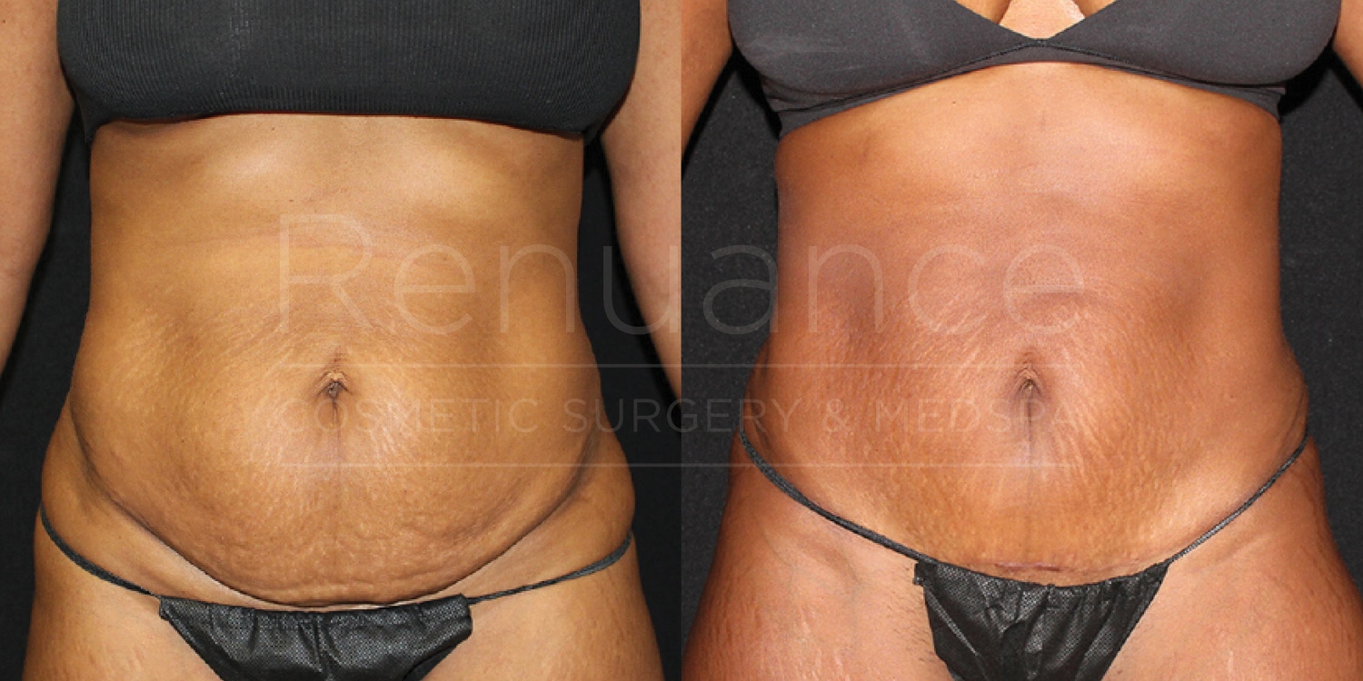 Before and after comparison of a woman's abdominal area. The left side shows the abdomen before cosmetic surgery, with visible skin laxity and fat deposits. The right side shows the abdomen after surgery, with a more toned and smoother appearance. The woman is wearing a dark-colored bra and underwear in both images.