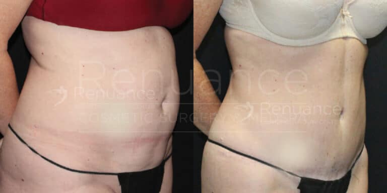Side-by-side comparison of a person’s midsection before and after undergoing liposuction. The left image shows the person's abdomen with more adipose tissue, while the right image displays a noticeably flatter and more contoured abdominal area post-surgery. The person is wearing different bras and similar black underwear in both images.