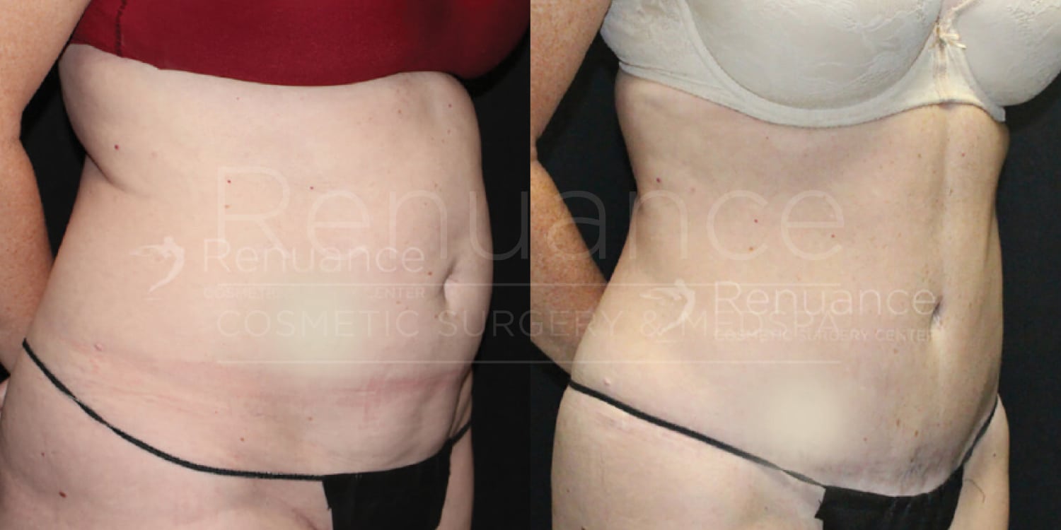 Side-by-side comparison of a person’s midsection before and after undergoing liposuction. The left image shows the person's abdomen with more adipose tissue, while the right image displays a noticeably flatter and more contoured abdominal area post-surgery. The person is wearing different bras and similar black underwear in both images.