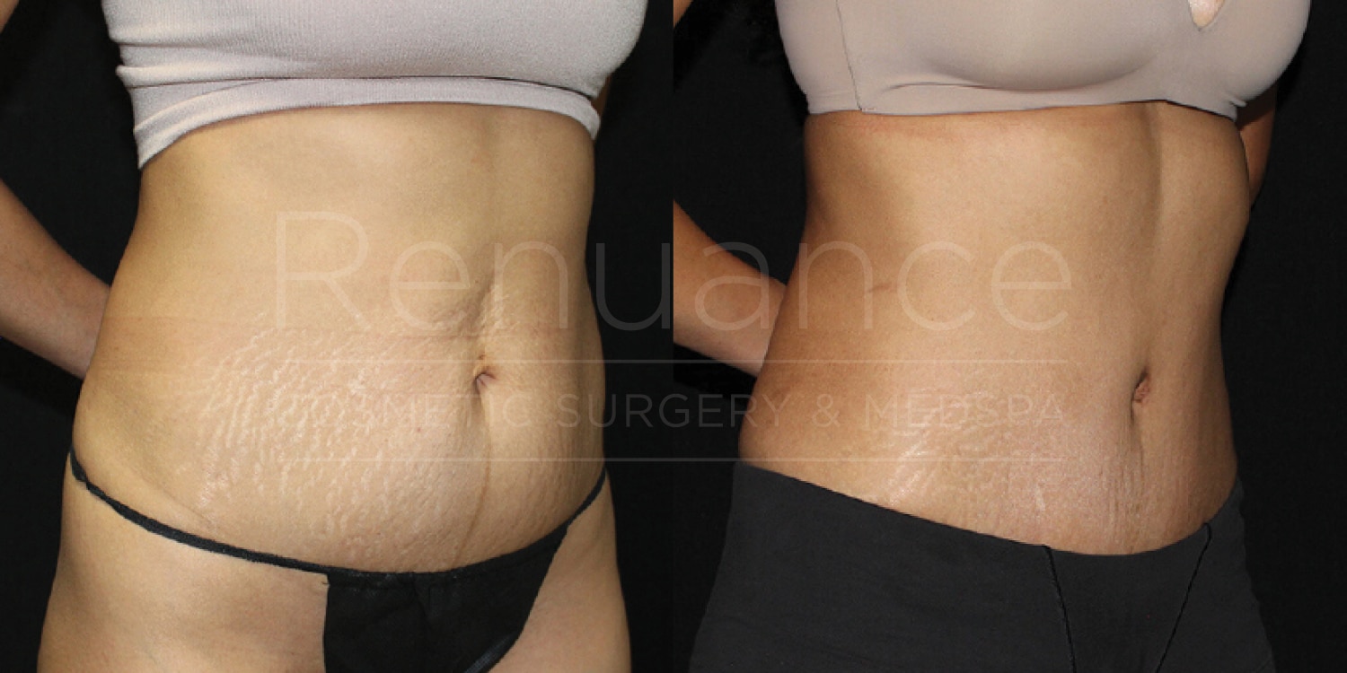 Before and after images of a woman's midsection following a cosmetic procedure. The left image shows her midsection with more visible stretch marks and loose skin, while the right image shows a smoother and more toned appearance. She is wearing different garments in each photo, highlighting the changes in her abdominal area.