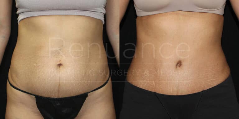 Before and after images showing the abdominal area of the same person, highlighting the results of a cosmetic procedure. The "before" image on the left shows more noticeable skin sagging and texture differences compared to the "after" image on the right, which displays a smoother and tighter appearance. The person is wearing different garments in each image.