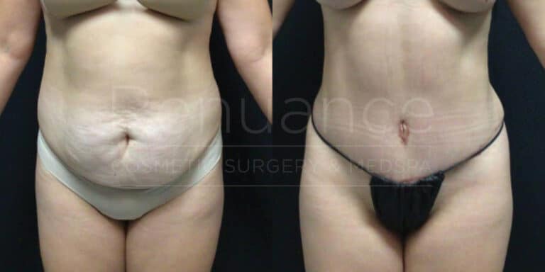 A before and after photo comparison of a person who has undergone a cosmetic procedure. In the "before" image, the individual is shown with a fuller abdomen. In the "after" image, the person's abdomen is noticeably slimmer and more toned, with visible reduction in abdominal fat and improved muscle definition. The person is wearing underwear in both images.