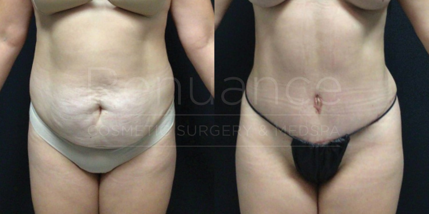 A before and after photo comparison of a person who has undergone a cosmetic procedure. In the "before" image, the individual is shown with a fuller abdomen. In the "after" image, the person's abdomen is noticeably slimmer and more toned, with visible reduction in abdominal fat and improved muscle definition. The person is wearing underwear in both images.