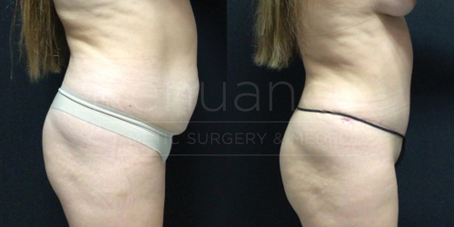 Side-by-side comparison of a woman's torso before and after a cosmetic surgery procedure. The woman is wearing minimal clothing to show the changes in her body, including a smoother and flatter abdomen in the after photo. The background is black.