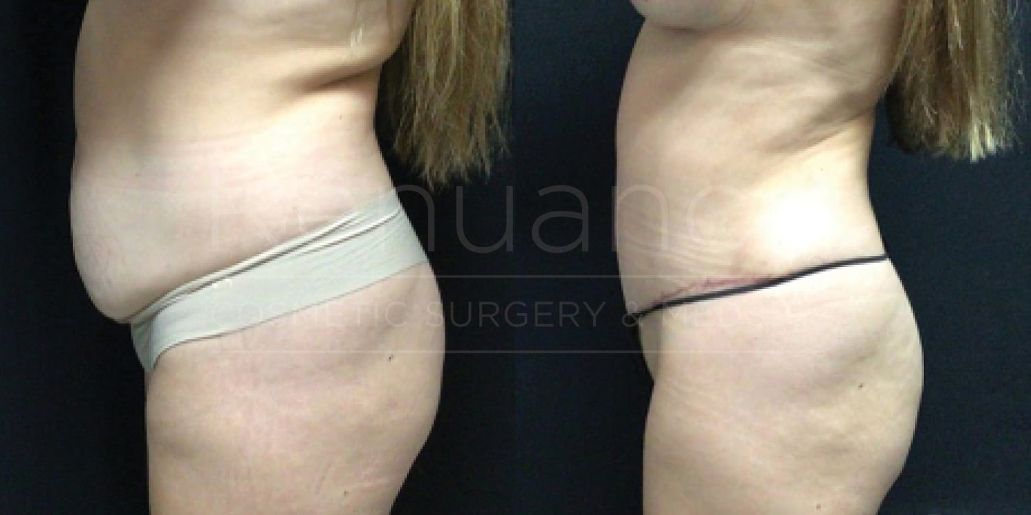 Side-by-side images showing the torso of a person before and after a surgical procedure. The left image depicts the person's side view before the surgery, with visible abdominal fullness. In the right image, taken post-surgery, the person's torso appears more contoured, with a surgical scar visible across the lower abdomen.