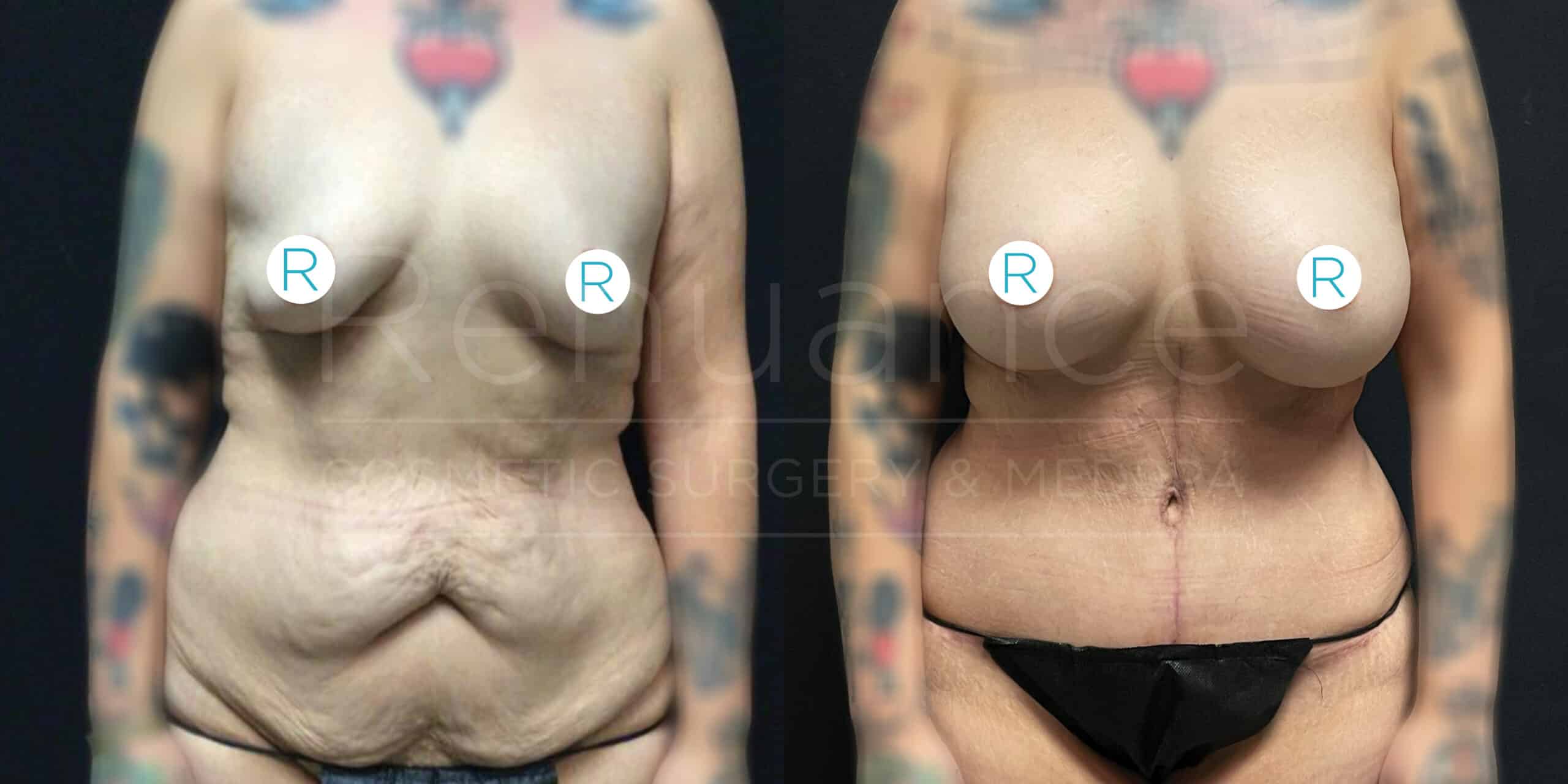 "Before and after comparison of a person who has undergone a cosmetic surgical procedure. The image on the left shows the individual prior to surgery with noticeable excess skin and sagging. The image on the right shows the same individual after surgery with a more toned and firm appearance, notably around the midsection and breast area. The individual has tattoos on their arms, and small stickers labeled 'R' cover the nipples in both images."