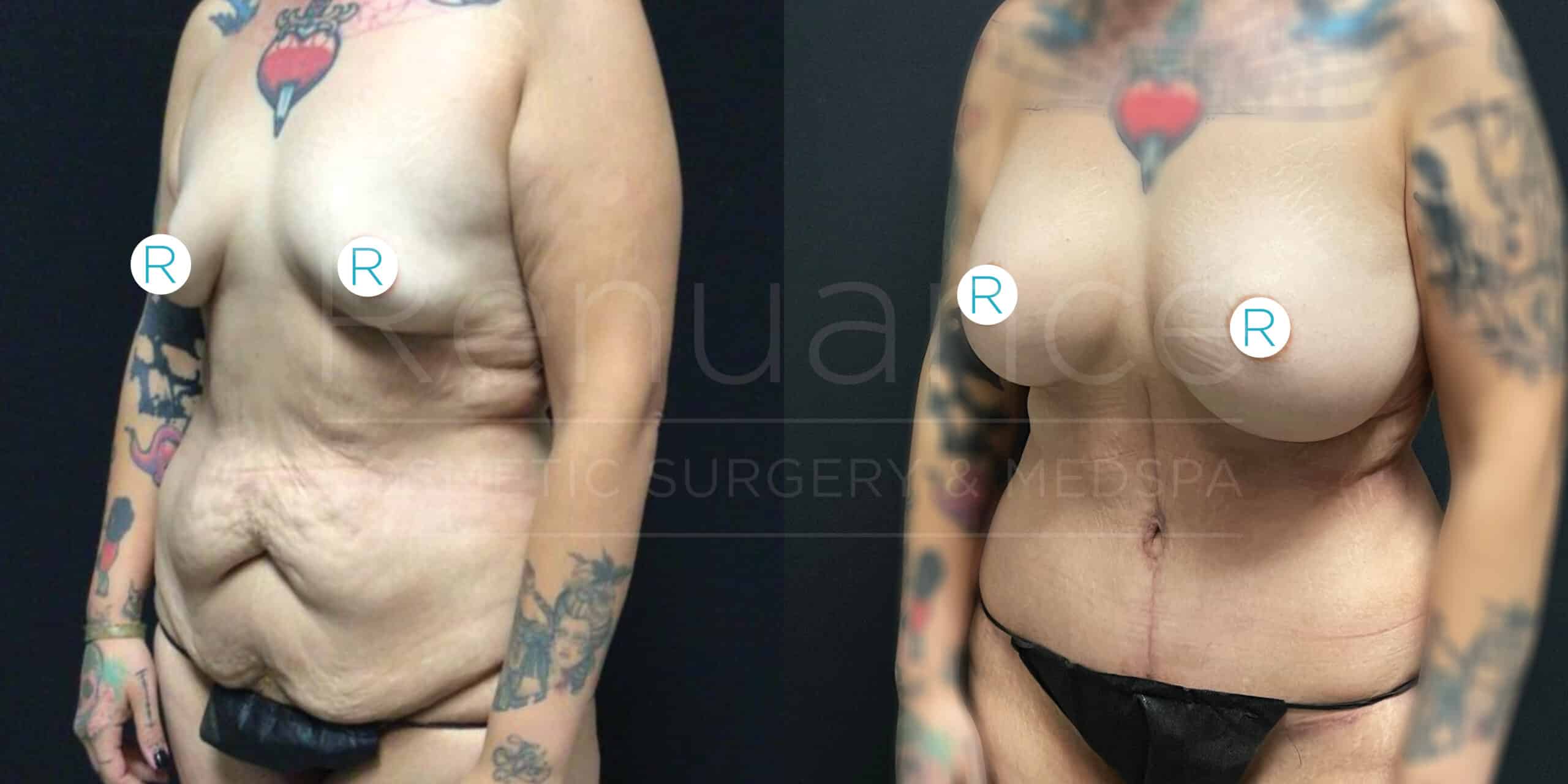 This image shows a before and after comparison of a person who has undergone body contouring surgery. The individual has notable tattoos on their arms and chest, and is standing against a black background. In the "before" photo on the left, the person has loose skin around the abdomen and smaller breasts. In the "after" photo on the right, the loose skin appears tightened, and the breasts appear larger and lifted, indicating the results of the surgical procedure. Small circular stickers marked "R" likely