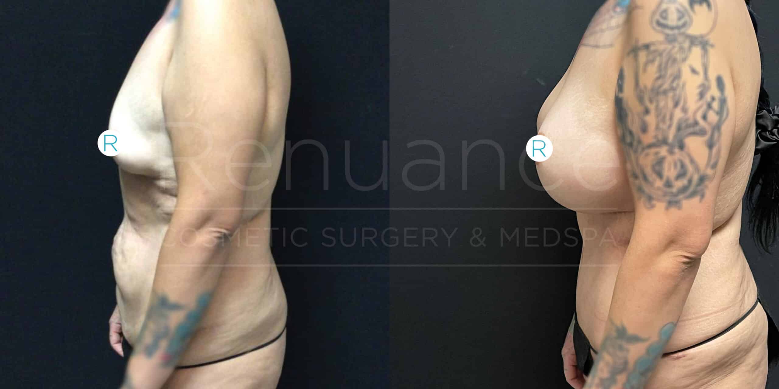 Side-by-side comparison of a person's body, showing before and after results of a cosmetic procedure. The left image depicts the person's profile before the procedure, while the right image shows the same person's profile after the procedure. Both images reveal changes in the abdominal and breast areas. The person's right arm, featuring multiple tattoos, is visible in both images. The background is neutral and dark, highlighting the changes in the body.