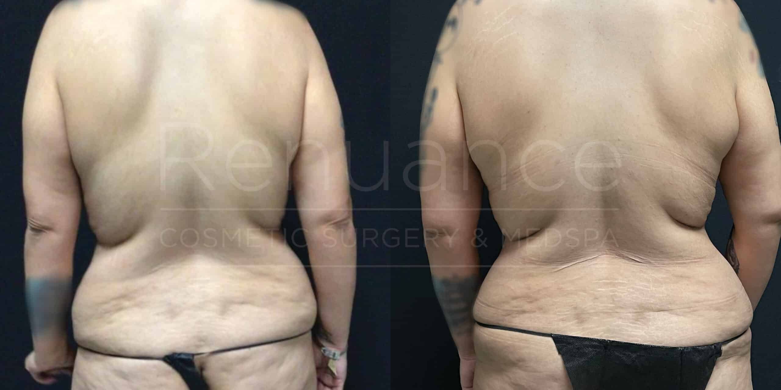 Before and after comparison of a person’s back following a cosmetic procedure. The left side shows the back before with more visible fat and skin folds, while the right side shows a noticeably slimmer and smoother back. The person is wearing black underwear in both images on a dark background.