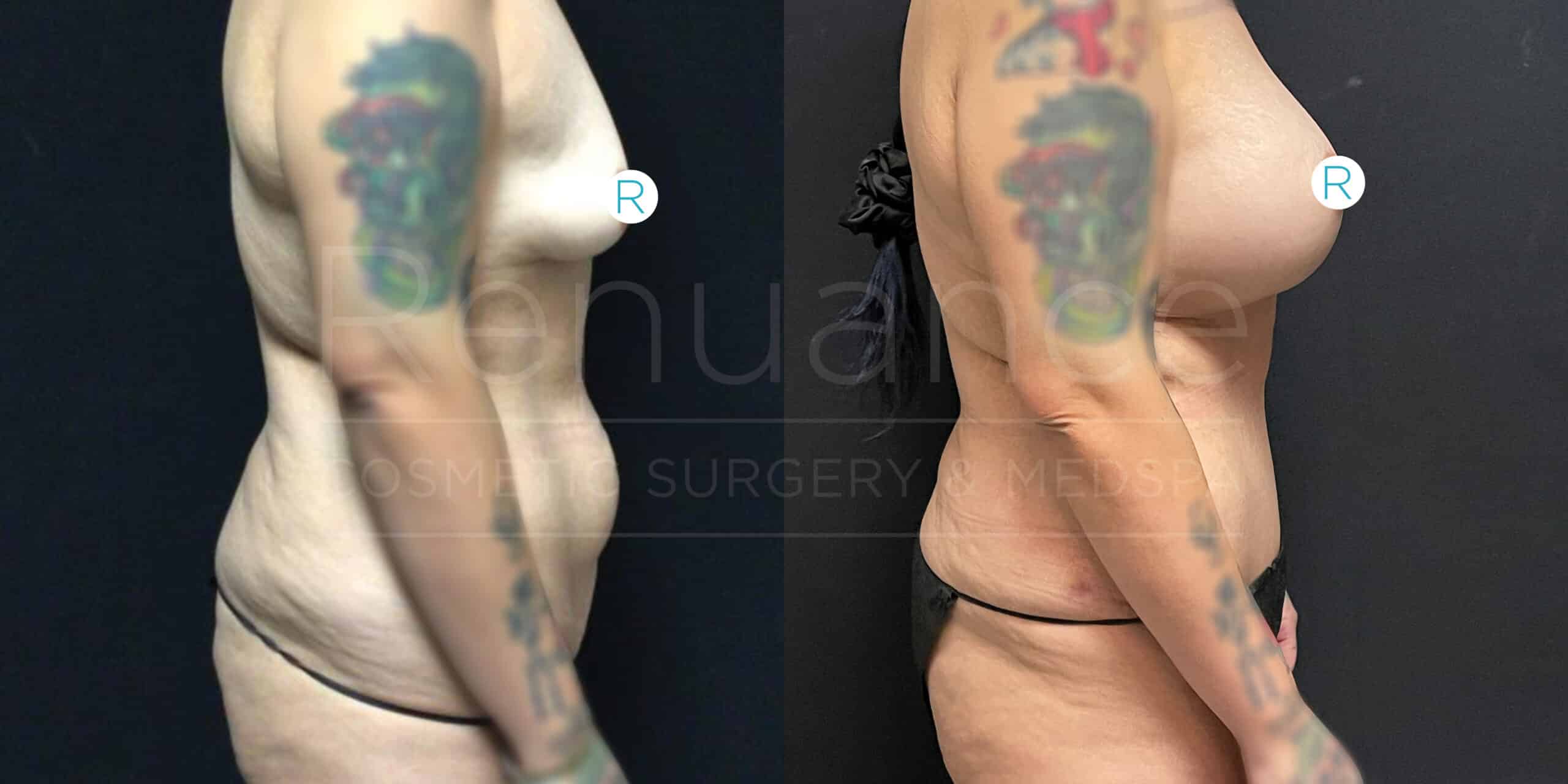 Side-by-side comparison showing two profile views of a person. The left image shows the person's torso and arms before a cosmetic procedure, and the right image shows the same person after the procedure, illustrating changes in body contour. The individual has a prominent tattoo on their upper left arm visible in both images.