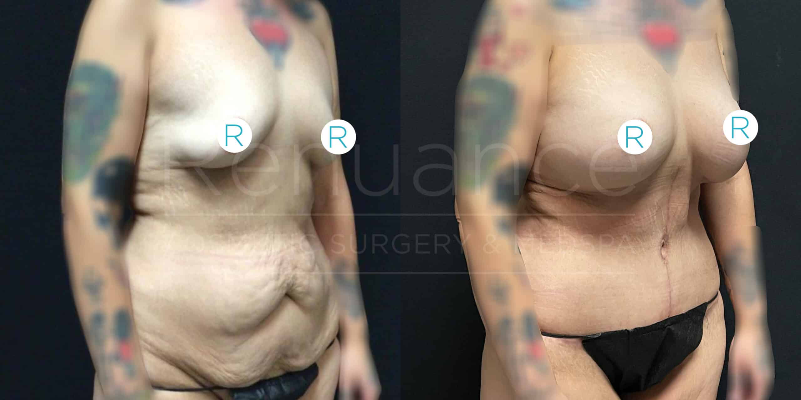 A side-by-side comparison of a person's torso shows the before and after effects of a cosmetic procedure. The person has visible tattoos on the upper arms, and there are markers labeled "R" on the chest in both images. The left image shows looser abdominal skin, while the right image shows tighter abdominal skin, a more contoured figure, and changes to the chest and midsection. The background is black in both images.