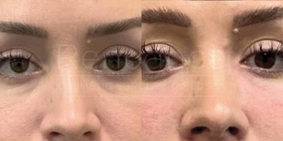 Close-up comparison image of a person's face before and after a cosmetic procedure. The left side shows the "before" state with a slightly droopy left eyelid, while the right side shows the "after" state with the eyelid lifted, giving a more symmetrical and alert appearance. The skin tone and texture appear more refined in the "after" image.
