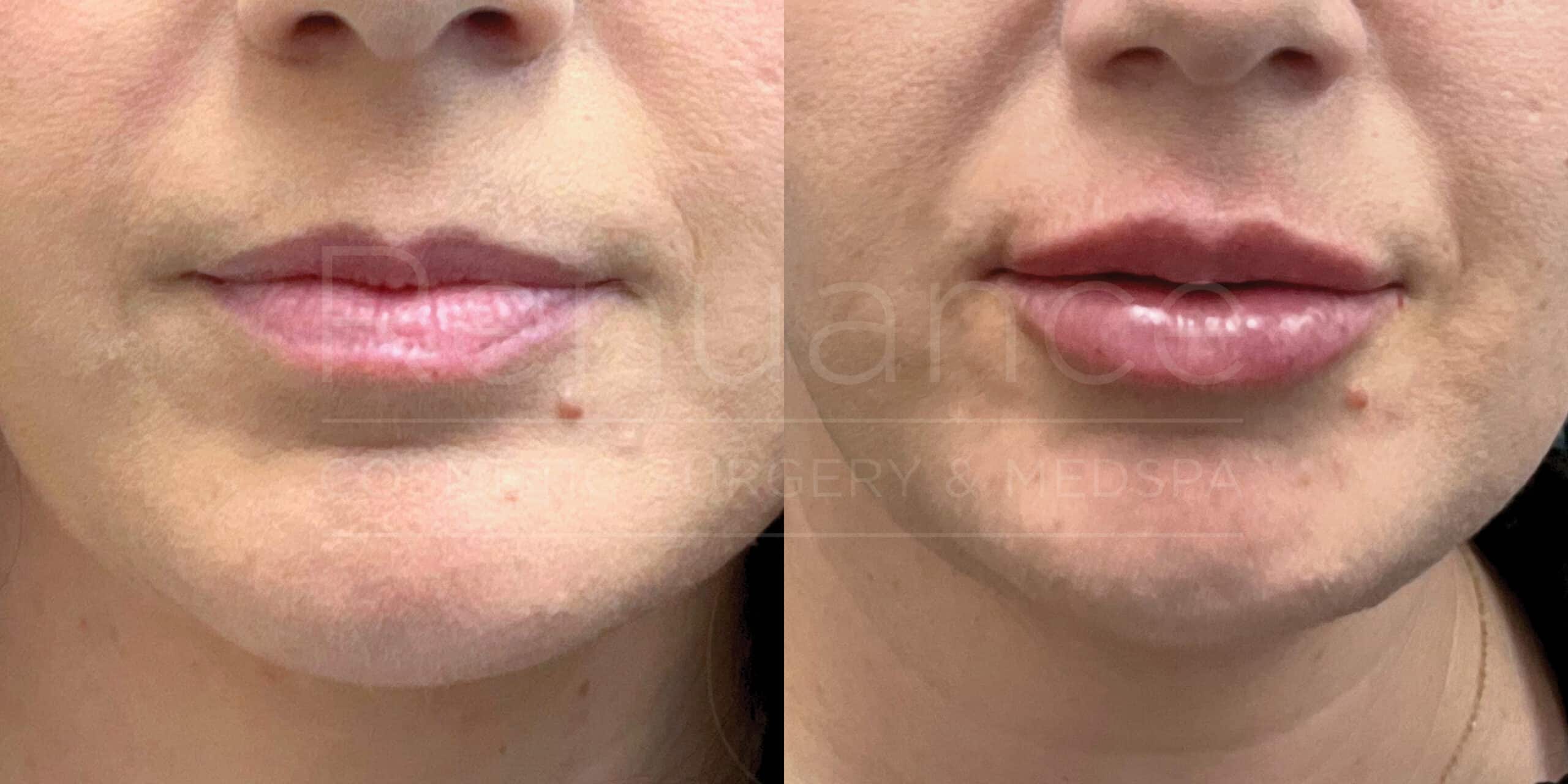 Close-up comparison images of a person's lips, showing before and after results of a cosmetic lip enhancement procedure. The left image shows their natural lips, while the right image shows fuller lips post-procedure.