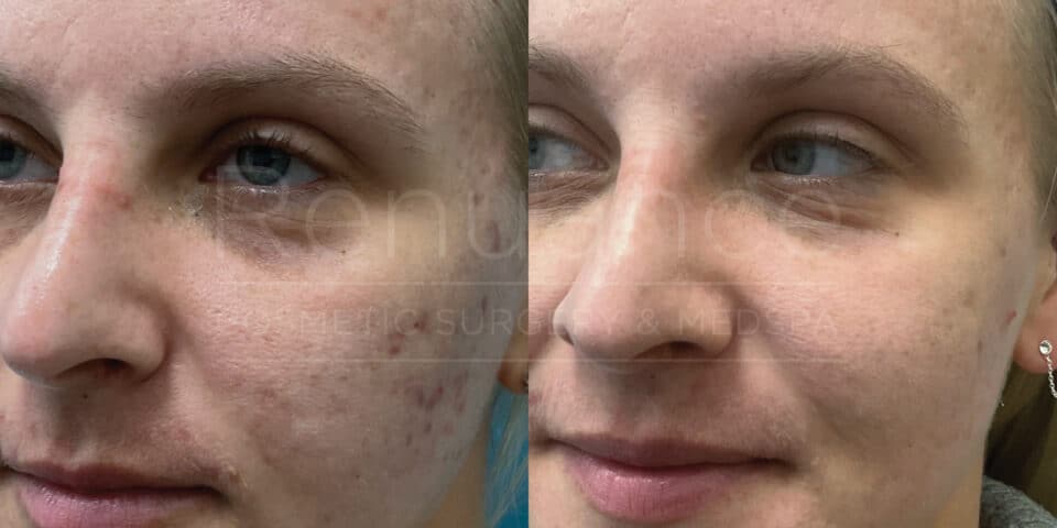 Side-by-side comparison photos showing a person's face before and after a skin treatment. The image on the left shows the person's face with visible acne and blemishes. The image on the right shows significant improvement, with clearer and smoother skin.