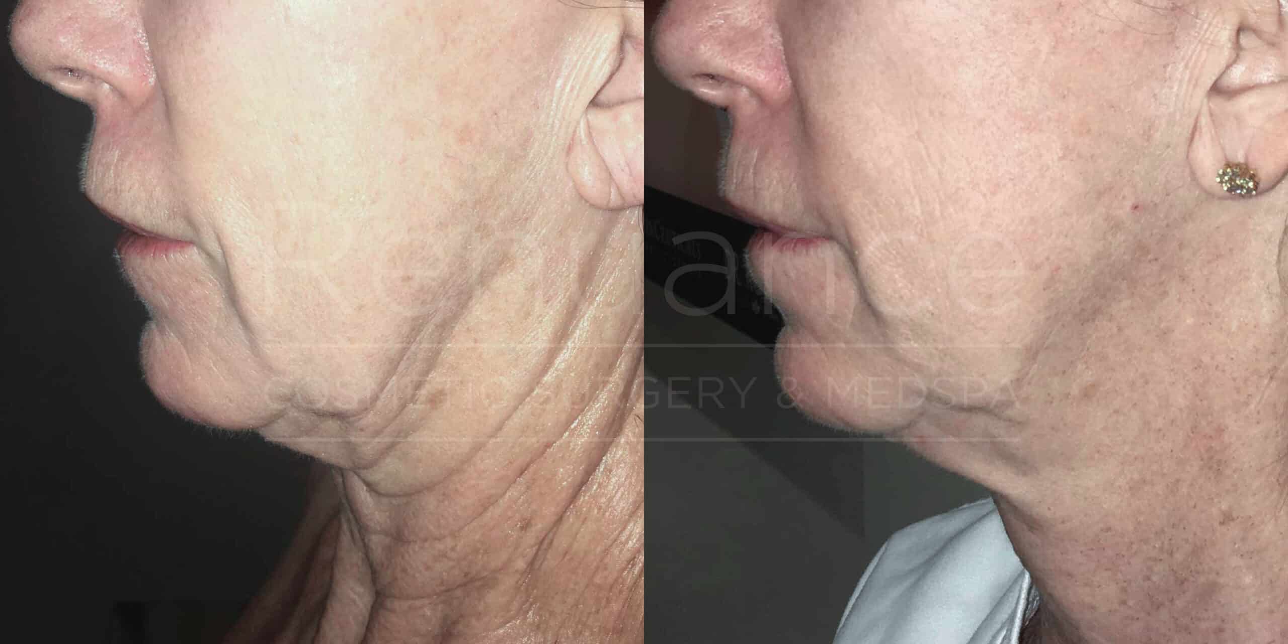 Side-by-side comparison showing the left profile views of an elderly person's lower face before and after a cosmetic procedure. The image on the left shows sagging skin with visible wrinkles and lines around the jaw and neck area. The image on the right shows a noticeable reduction in sagging and wrinkles, indicating tighter and smoother skin after the procedure. The person has a gold earring in both images.