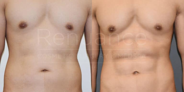 The image shows a comparison of a person's torso before and after a cosmetic procedure. The left side depicts the torso before the procedure, with a softer and fuller appearance. The right side shows the torso after the procedure, with a more toned and defined look. The background has the text "Renaissance Cosmetic Surgery & Medspa" overlaid across the image.