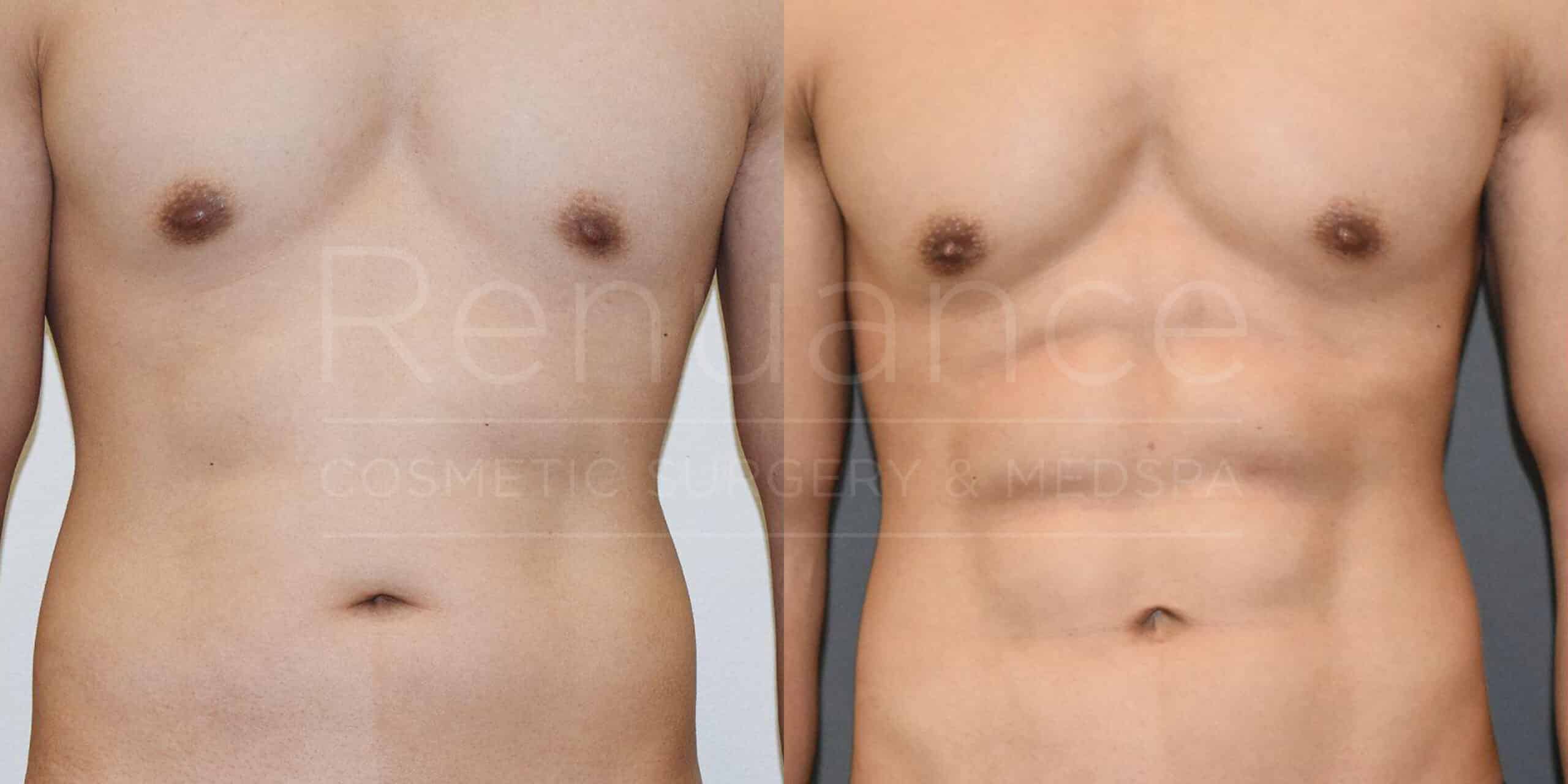 The image shows a comparison of a person's torso before and after a cosmetic procedure. The left side depicts the torso before the procedure, with a softer and fuller appearance. The right side shows the torso after the procedure, with a more toned and defined look. The background has the text "Renaissance Cosmetic Surgery & Medspa" overlaid across the image.