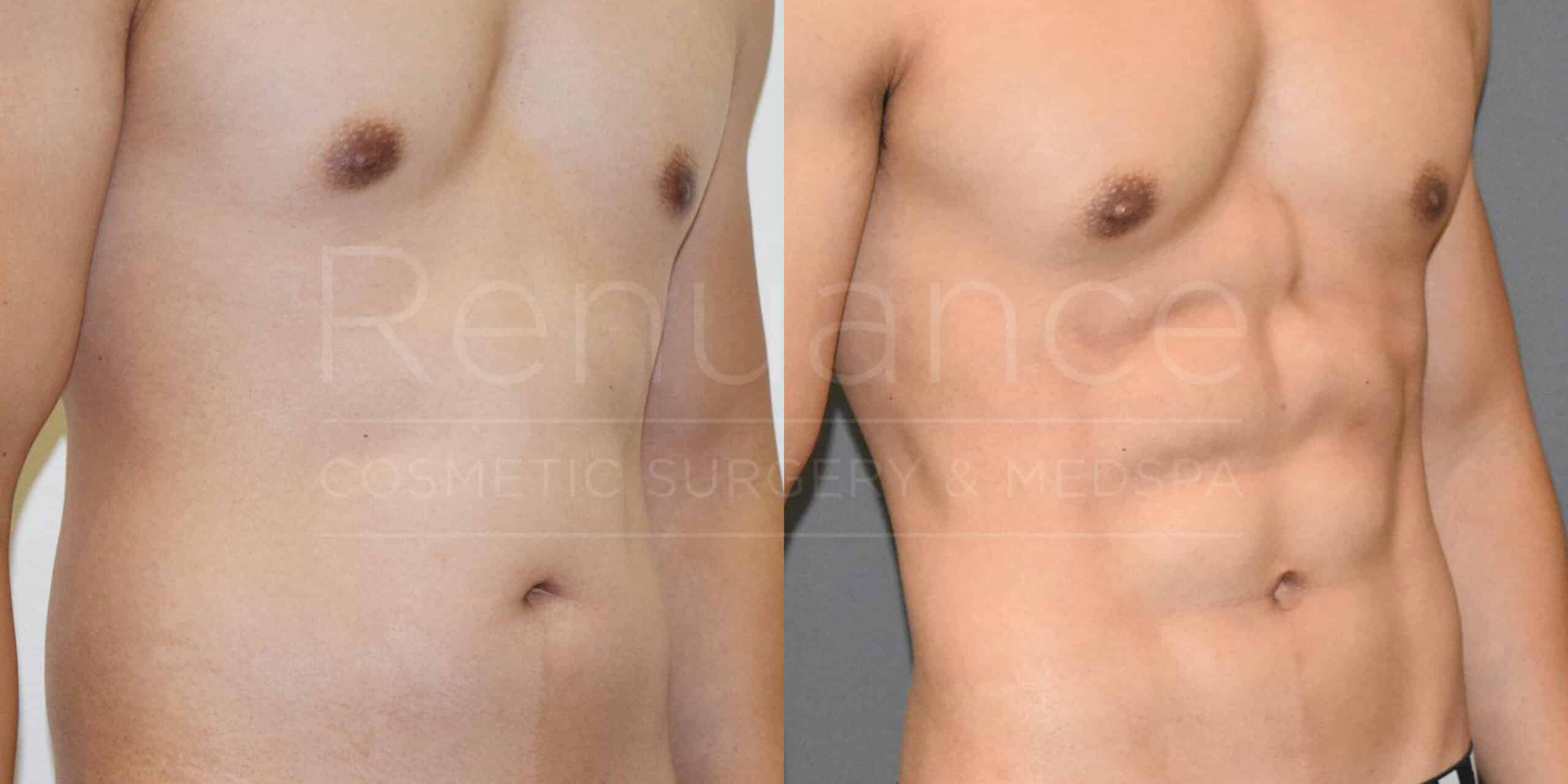 Side-by-side comparison showing the torso of a man before (left) and after (right) undergoing cosmetic surgery. The "before" image shows a smoother, less defined abdomen, while the "after" image depicts a more toned and muscular appearance with visible abs. The text "Renuance Cosmetic Surgery & Med Spa" is faintly overlaid on the images.