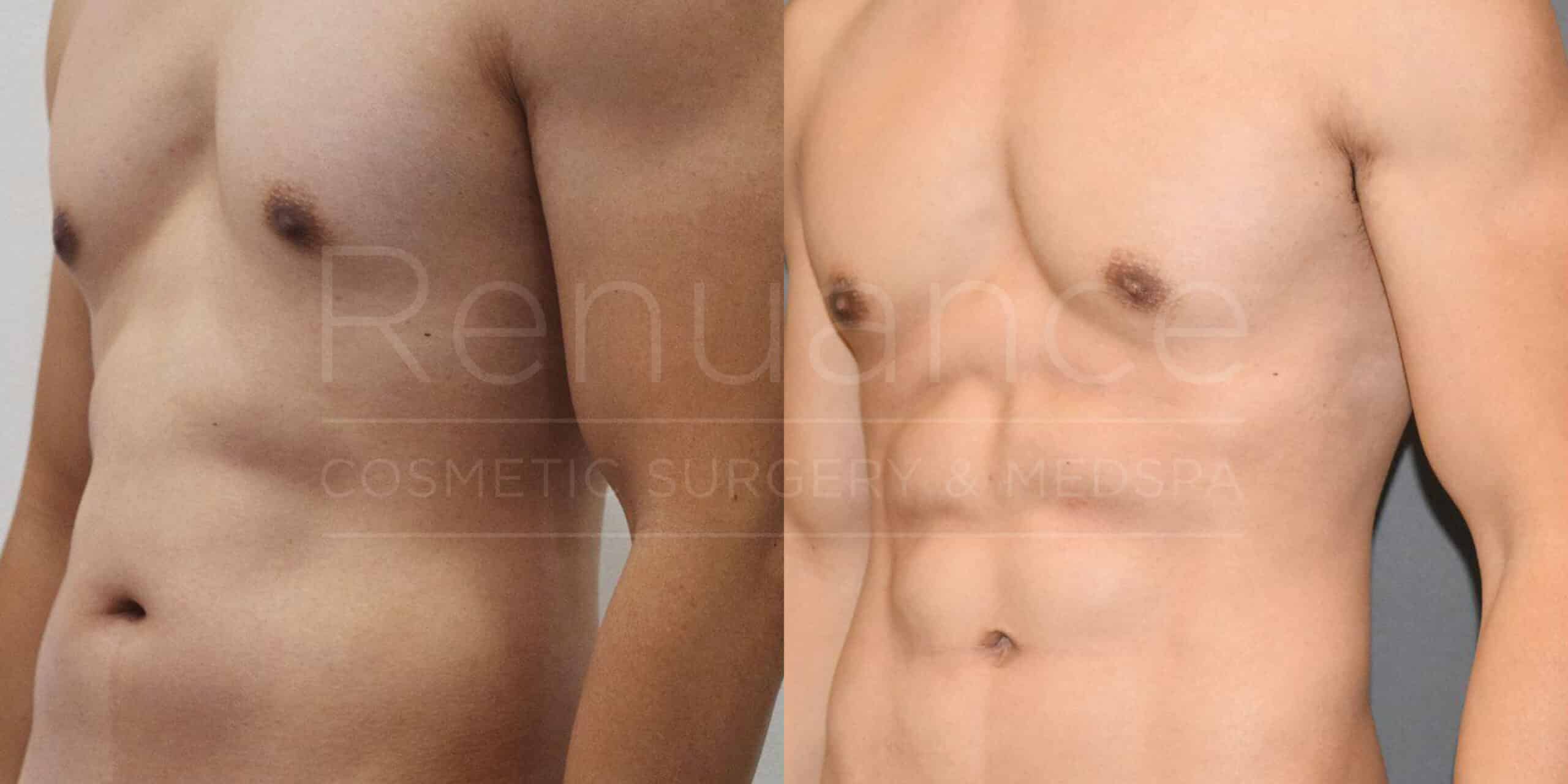 A before-and-after image showing the torso of a man. The left side of the image depicts the torso before a cosmetic procedure, while the right side shows the torso post-procedure, illustrating visible improvements in muscle definition and tone. The background text reads "Renuance Cosmetic Surgery & Medspa."