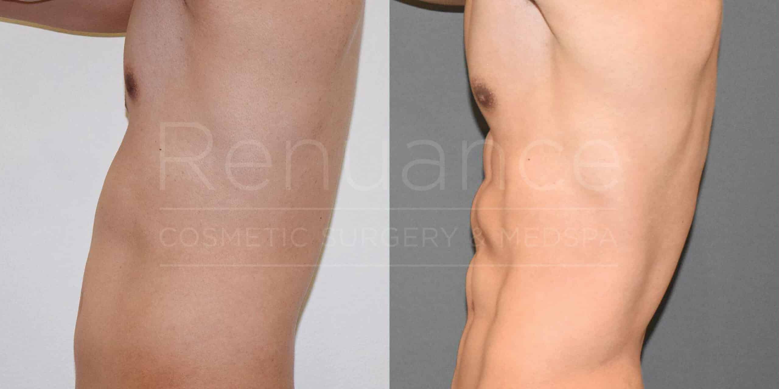 The image shows a side-by-side comparison of the abdominal area of a person before and after a cosmetic surgery procedure. The left side depicts the person's abdomen before surgery, while the right side shows a more defined and toned abdominal area post-surgery. The background on the left side is white, and the background on the right side is gray. The word "Renaissance" along with "Cosmetic Surgery & Medspa" is faintly visible across the center of the image.