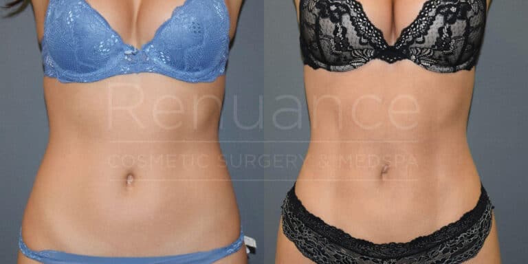 A side-by-side comparison of a woman's torso before and after an unspecified cosmetic procedure. The left image shows a woman wearing a blue bra and matching underwear, while the right image shows the same woman in a black lace bra and matching underwear. Both images focus on the woman's midsection, highlighting changes in appearance. The background is a neutral grey, and the words "Renuance Cosmetic Surgery & Med Spa" are faintly visible on both images.