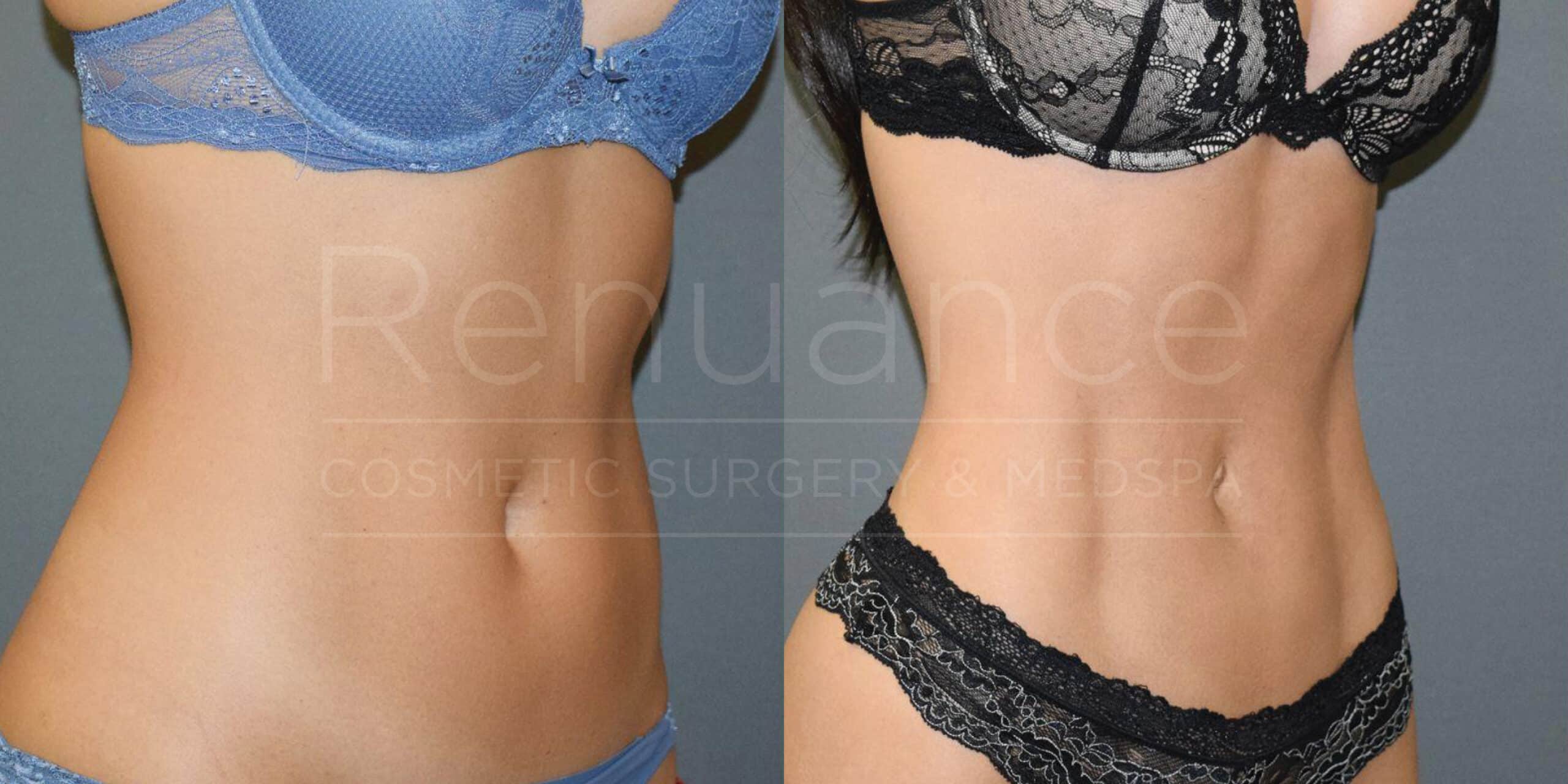 Side-by-side images showing a close-up of a woman's midsection before and after a cosmetic surgery procedure. The woman is wearing blue lace underwear in the left image and black lace underwear in the right image, illustrating the changes in her abdominal area. The background is neutral gray. Text overlay reads "Renuance Cosmetic Surgery & Med Spa."