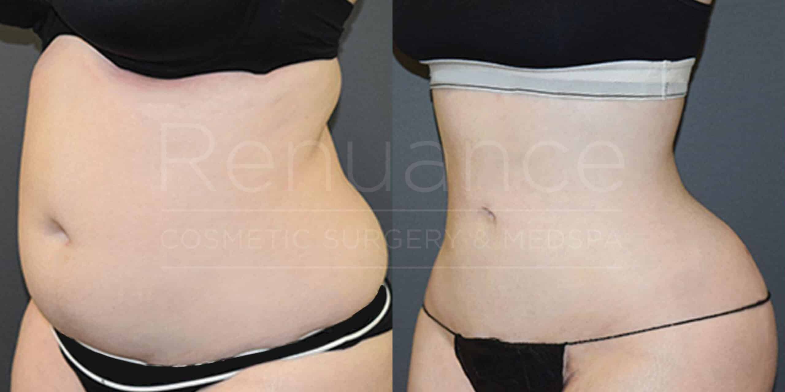 A side-by-side comparison of two images illustrating the before and after results of a cosmetic procedure. The first image on the left shows a person with a slightly larger abdomen and more pronounced body contours. The second image on the right displays the same person with a noticeably flatter abdomen and smoother body contours, indicating the changes post-procedure. Both images are taken from the same angle, emphasizing the transformation. The person is wearing similar black undergarments in both images.