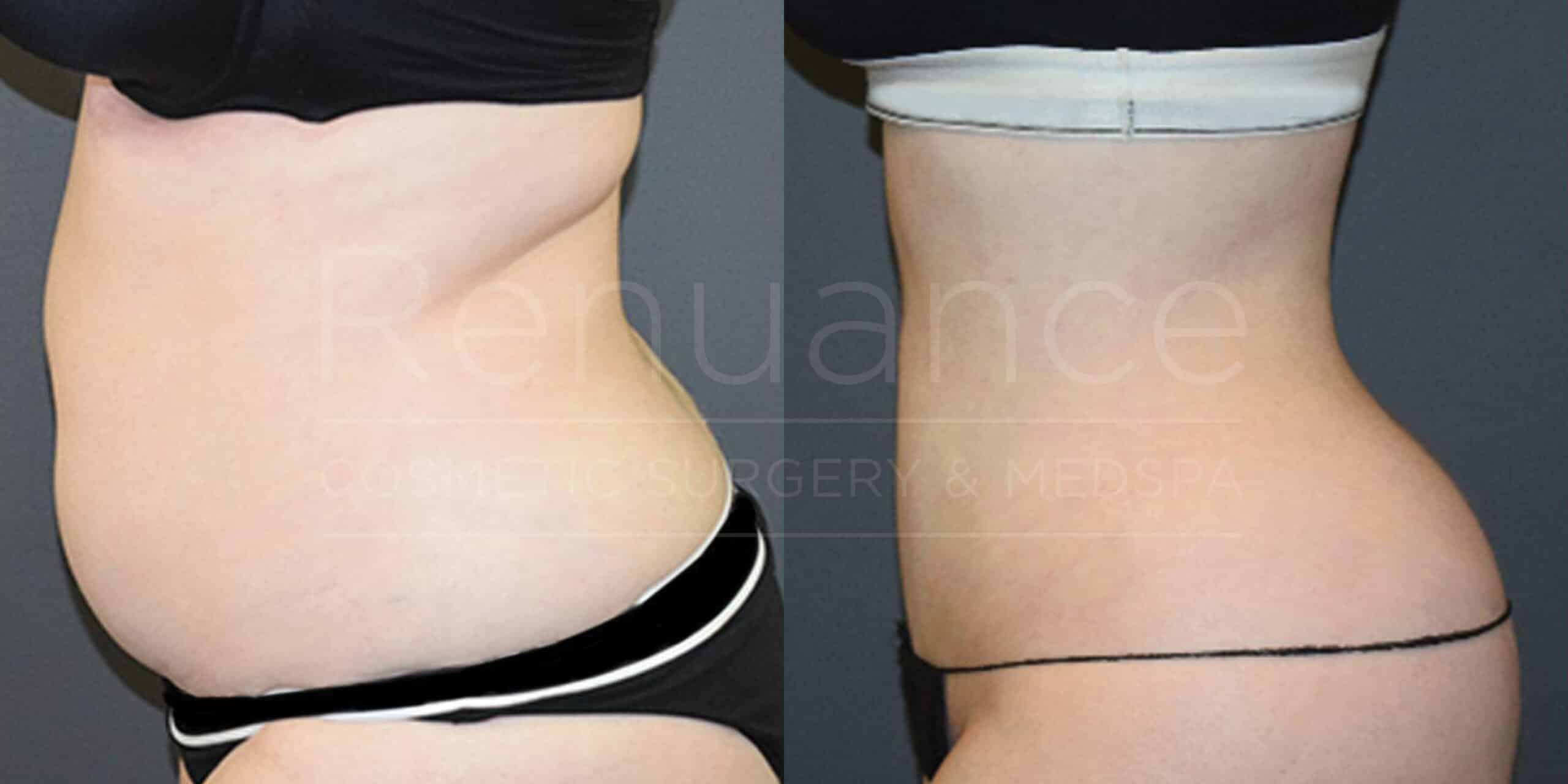 Side-by-side images of a woman's abdomen and waist, showing a "before and after" comparison. In the first image, her abdominal area appears larger, and in the second image, the abdominal area appears flatter and more toned. She is wearing a black bra and black underwear in the first image, and different undergarments in the second image.