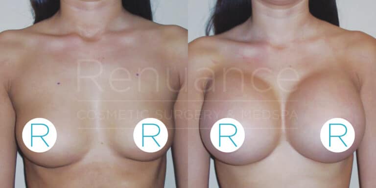 A before and after comparison image of a woman's upper body showing the results of breast augmentation surgery. The left side of the image shows the woman before the surgery with smaller breasts, while the right side of the image shows the woman after the surgery with noticeably larger and fuller breasts. Both images have large "R" labels over the nipples for modesty. The background contains a watermark with the text "Renuance COSMETIC SURGERY & MEDSPA."