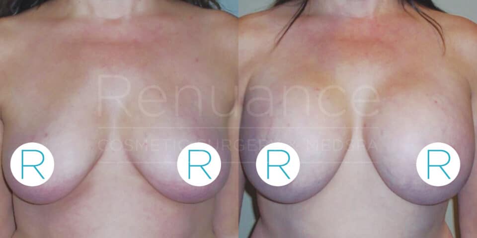 A before and after comparison image of a woman's chest, showing the results of a breast procedure. The left side displays the "before" state, with the breasts appearing larger and sagging. The right side shows the "after" state, with the breasts appearing lifted and firmer. The background features the text "Renuance Cosmetic Surgery & Medspa." Circular icons with the letter "R" cover the nipples for modesty.