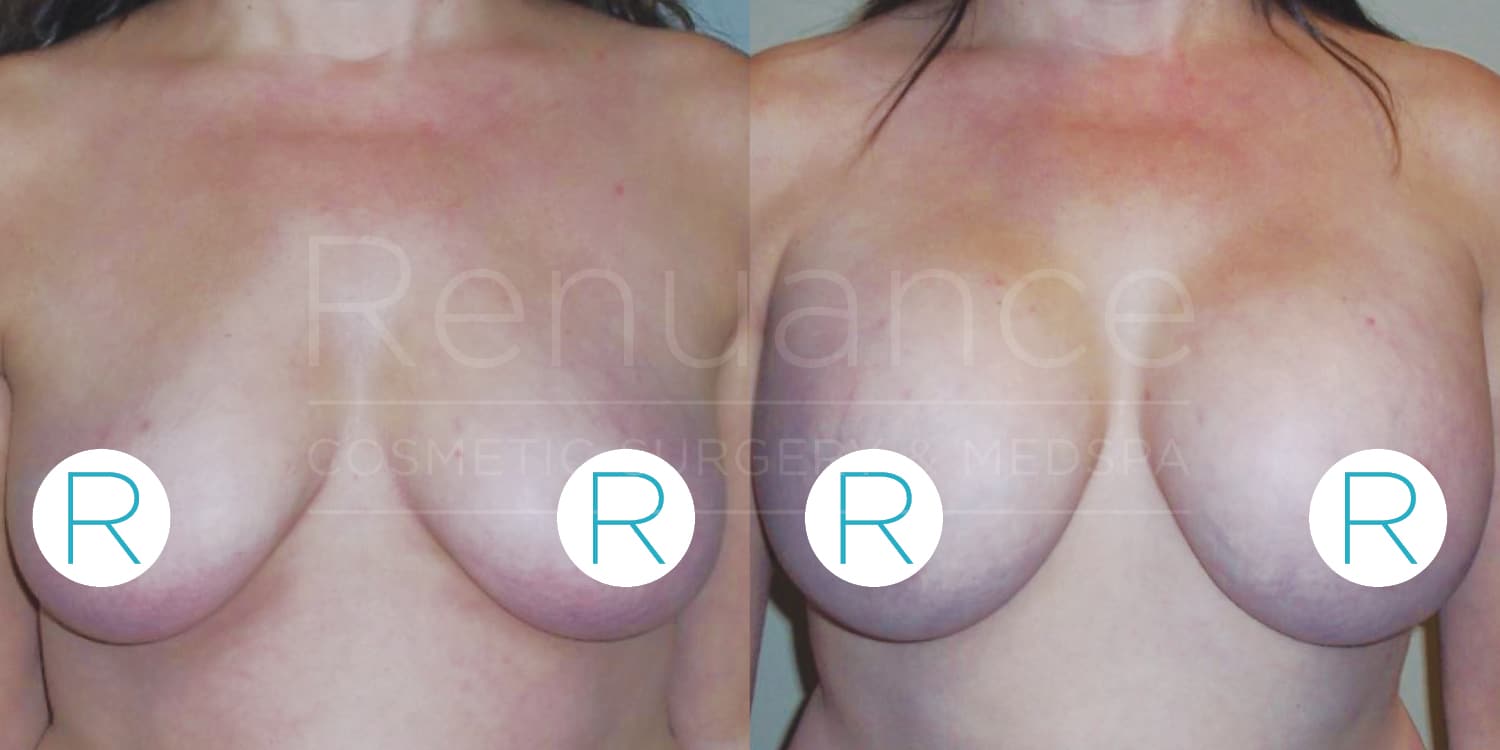A before and after comparison image of a woman's chest, showing the results of a breast procedure. The left side displays the "before" state, with the breasts appearing larger and sagging. The right side shows the "after" state, with the breasts appearing lifted and firmer. The background features the text "Renuance Cosmetic Surgery & Medspa." Circular icons with the letter "R" cover the nipples for modesty.