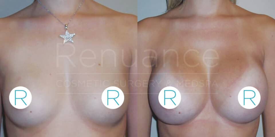 Comparison image showing a person's torso before and after breast augmentation surgery. The left side of the image shows the person before the surgery, and the right side shows the person after the surgery. Both images cover the chest area, with blue labeled circles covering the nipples for privacy. The person is wearing a necklace with a star pendant. The background has partial text that reads "Renuance Cosmetic Surgery & Medispa".