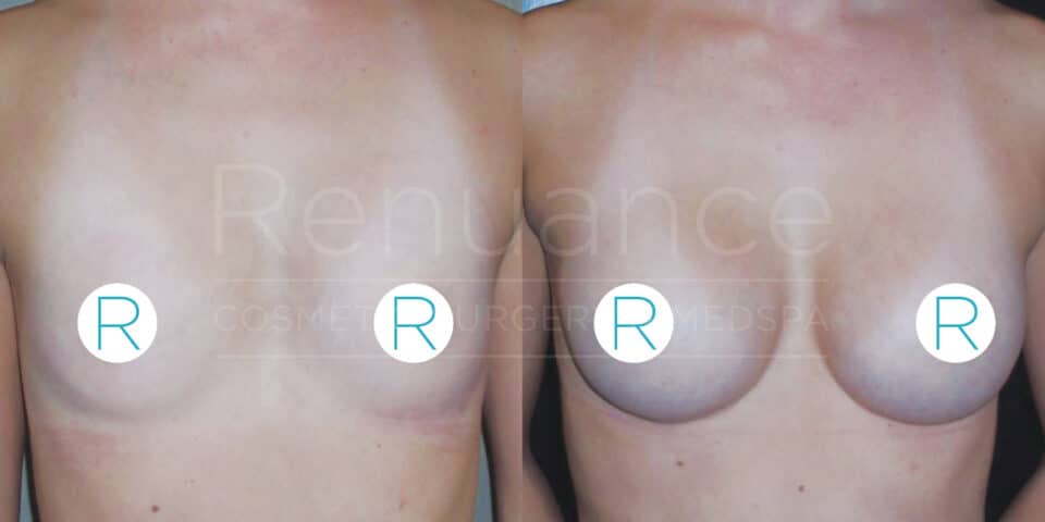 Comparison image showing the results of a breast augmentation procedure. The left side depicts the patient before surgery, and the right side shows the enhanced breast size and shape after the procedure. The image includes the branding of "Renuance Cosmetic Surgery Medspa".