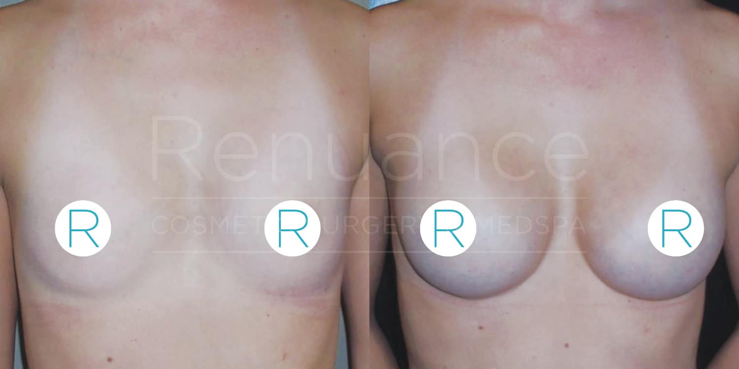 Comparison image showing the results of a breast augmentation procedure. The left side depicts the patient before surgery, and the right side shows the enhanced breast size and shape after the procedure. The image includes the branding of "Renuance Cosmetic Surgery Medspa".