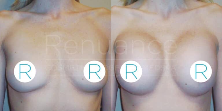 Before and after comparison of a person's chest showing the results of a cosmetic breast procedure. The left side shows the chest before the procedure, while the right side shows the chest after the procedure, indicating enhancement and modification. The image has a watermark from "Renuance Cosmetic Surgery Center". The letters "R" are used to cover the nipples for modesty.