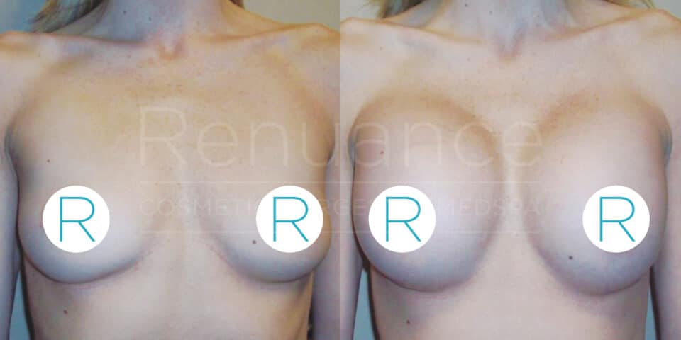 Before and after comparison of a person's chest showing the results of a cosmetic breast procedure. The left side shows the chest before the procedure, while the right side shows the chest after the procedure, indicating enhancement and modification. The image has a watermark from "Renuance Cosmetic Surgery Center". The letters "R" are used to cover the nipples for modesty.