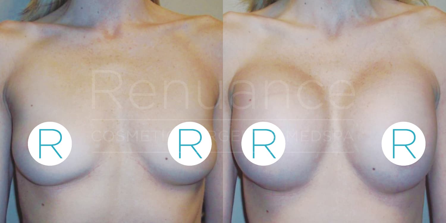 Before and after comparison of a person's chest showing the results of a cosmetic breast procedure. The left side shows the chest before the procedure, while the right side shows the chest after the procedure, indicating enhancement and modification. The image has a watermark from "Renuance Cosmetic Surgery Center". The letters "R" are used to cover the nipples for modesty.