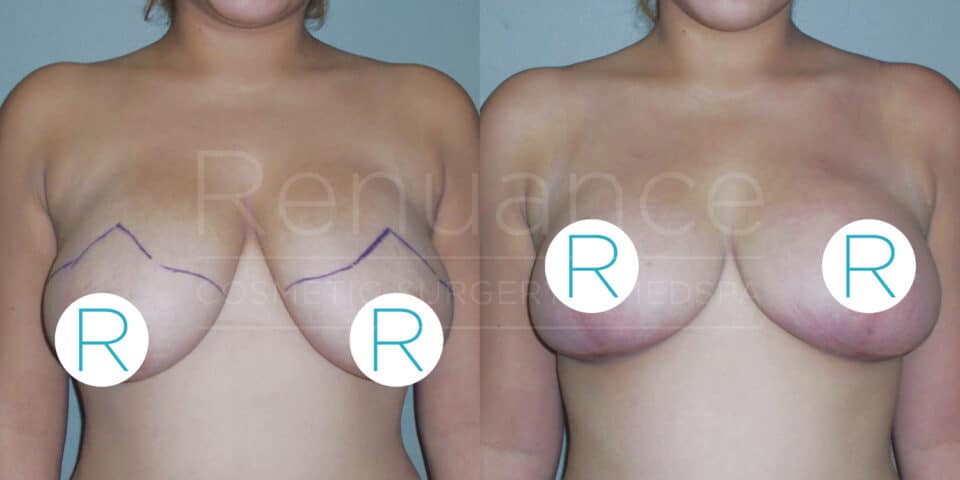 Two side-by-side images show the torso of an individual before and after a breast augmentation procedure. In the "before" image on the left, there are markings on the skin indicating surgical planning. In the "after" image on the right, the individual shows enlarged and more elevated breasts. Both images have circular stickers labeled "R" covering part of the breast area for modesty.