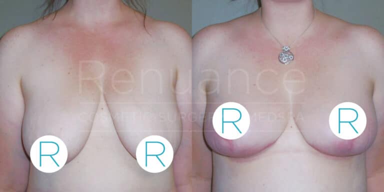 A before and after photo of a woman's chest area showing the results of a breast augmentation procedure. The left image shows the woman's breasts pre-procedure, and the right image shows the breasts post-procedure. Both images have the "Renuance Cosmetic Surgery Medspa" watermark, and there is a circular "R" symbol covering part of the breasts for modesty. The woman is not wearing a shirt in either photo, and she has a necklace with a pendant in the after image.