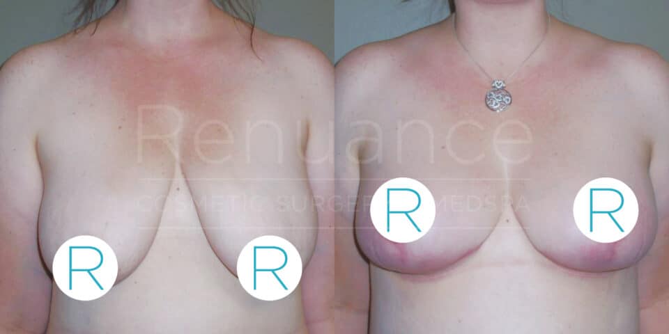 A before and after photo of a woman's chest area showing the results of a breast augmentation procedure. The left image shows the woman's breasts pre-procedure, and the right image shows the breasts post-procedure. Both images have the "Renuance Cosmetic Surgery Medspa" watermark, and there is a circular "R" symbol covering part of the breasts for modesty. The woman is not wearing a shirt in either photo, and she has a necklace with a pendant in the after image.