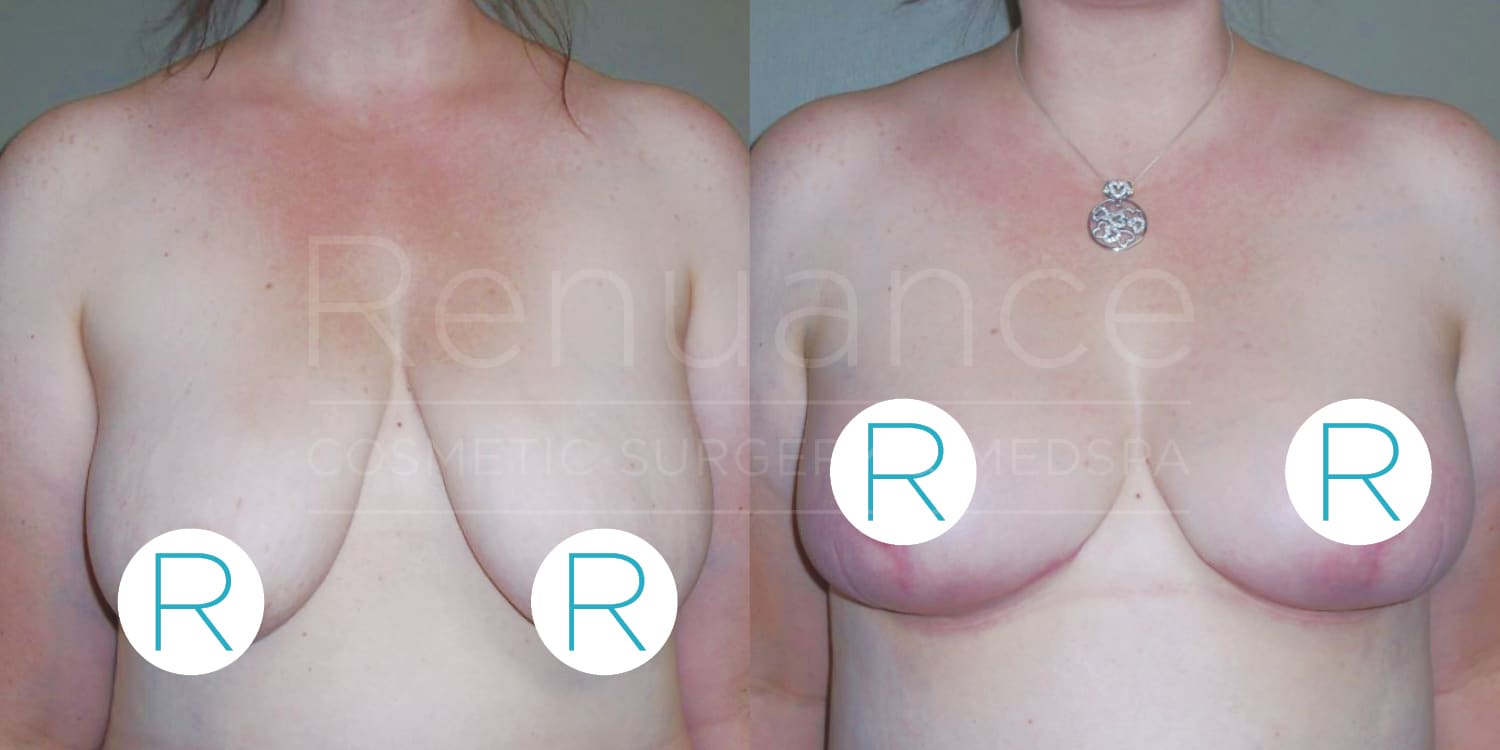 A before and after photo of a woman's chest area showing the results of a breast augmentation procedure. The left image shows the woman's breasts pre-procedure, and the right image shows the breasts post-procedure. Both images have the "Renuance Cosmetic Surgery Medspa" watermark, and there is a circular "R" symbol covering part of the breasts for modesty. The woman is not wearing a shirt in either photo, and she has a necklace with a pendant in the after image.