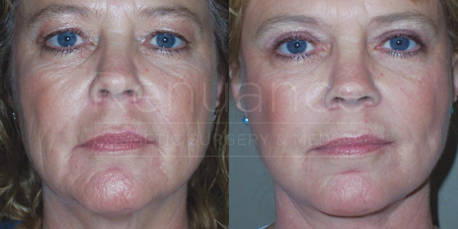 A side-by-side comparison of two close-up photographs showing a woman's face before and after a cosmetic procedure. In the "before" image (left), the woman exhibits visible wrinkles and sagging skin. In the "after" image (right), her skin appears smoother, tighter, and with fewer wrinkles. The overall effect suggests a more youthful and refreshed appearance.