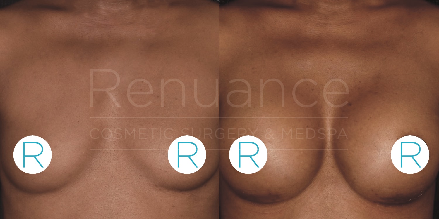 Side-by-side comparison of a person's chest before and after cosmetic breast enhancement surgery. The image on the left shows the "before" state, while the image on the right shows the "after" state with increased breast size. Each photo has a circular label with the letter "R" on the lower part of each breast. The background text says "Renuance COSMETIC SURGERY & MEDSPA."