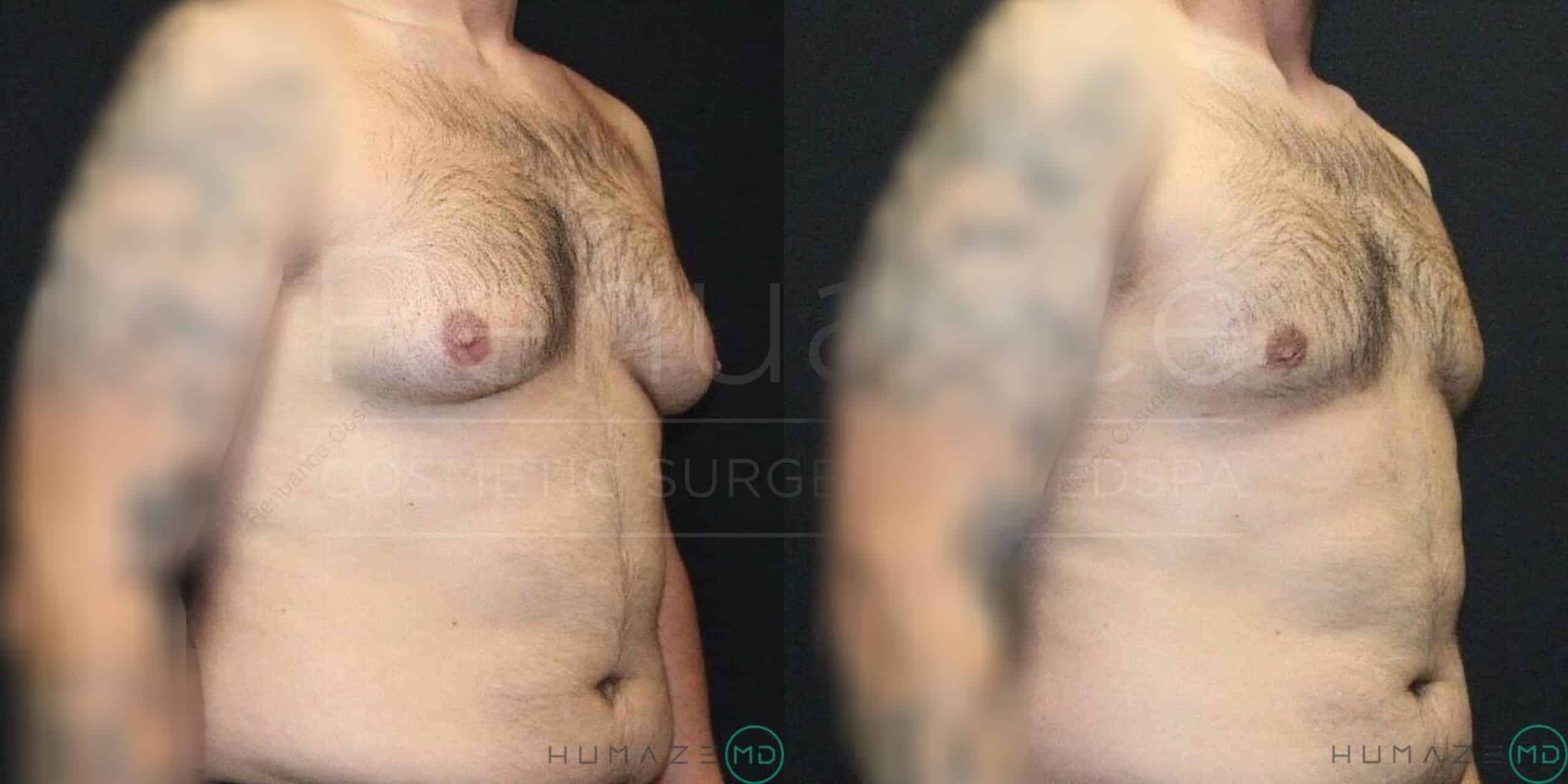 "Side-by-side comparison of a person's torso before and after breast reduction surgery. The left image shows the torso before surgery, while the right image shows the torso after surgery, with a noticeable reduction in breast size. The arms are pixelated in both images."
